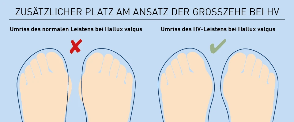 hallux valgus