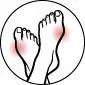 Hallux valgus